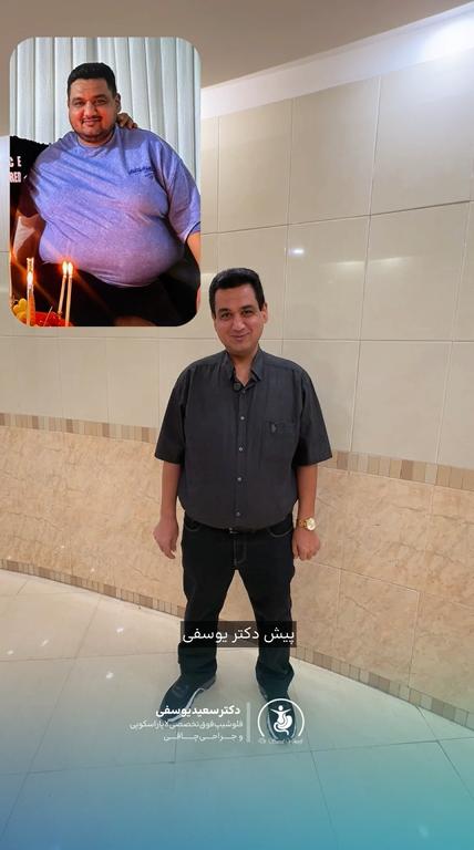 کاهش ۴۴ کیلو در ۷ ماه | بهبود شرایط بیماری زمینه‌ای با جراحی چاقی